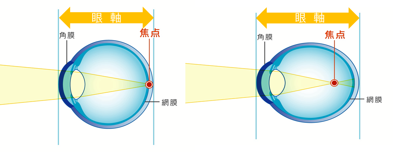 近 視 | 魚町眼科